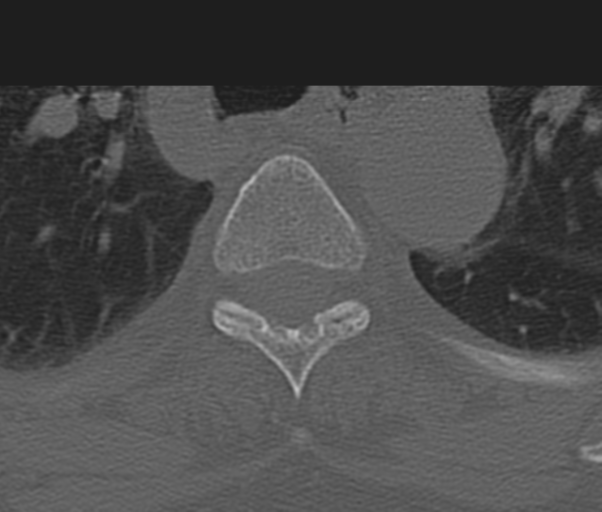 Atlanto-axial subluxation (Radiopaedia 36610-38176 Axial bone window 71).png