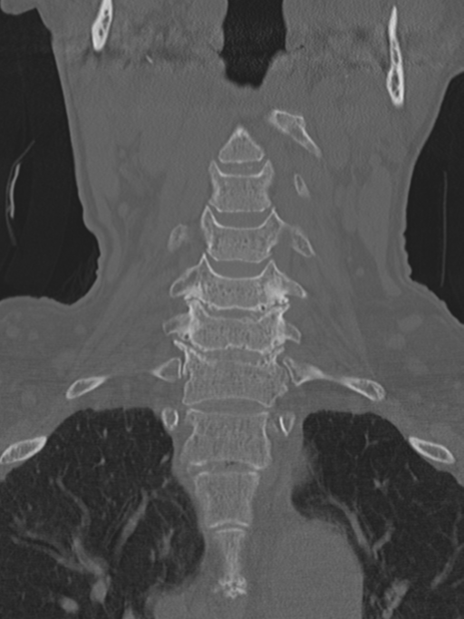 Atlanto-axial subluxation (Radiopaedia 36610-38176 Coronal bone window 17).png