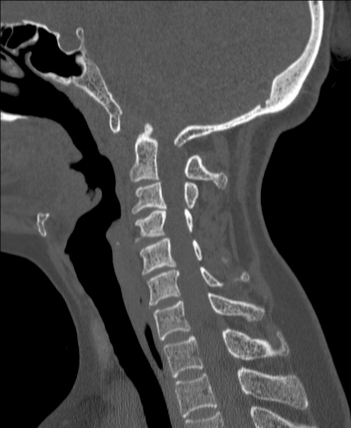 Atlanto-occipital assimilation with basilar invagination (Radiopaedia 70122-80188 Sagittal bone window 76).jpg