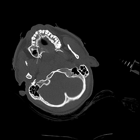 File:Atlanto-occipital dissociation (Traynelis type 1), C2 teardrop fracture, C6-7 facet joint dislocation (Radiopaedia 87655-104061 Axial bone window 11).jpg