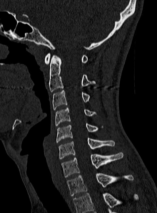 Atlantoaxial subluxation (Radiopaedia 44681-48450 Sagittal bone window 74).jpg