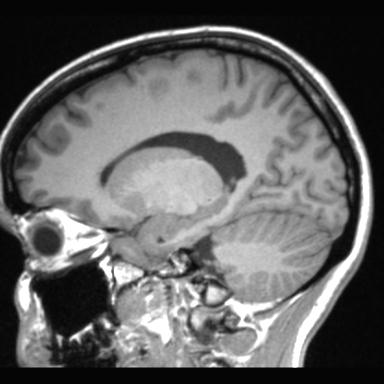 Atretic encephalocoele with inferior vermis hypoplasia (Radiopaedia 30443-31108 Sagittal T1 49).jpg