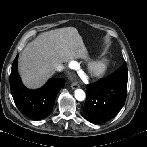 Atypical hepatocellular carcinoma (Radiopaedia 41744-44698 A 10).jpg