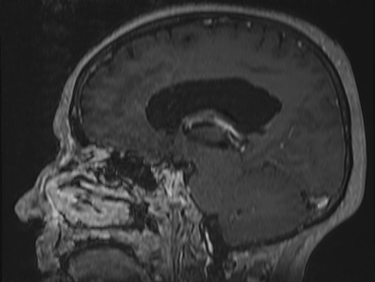 Atypical meningioma (Radiopaedia 62985-71406 Sagittal T1 C+ 37).jpg