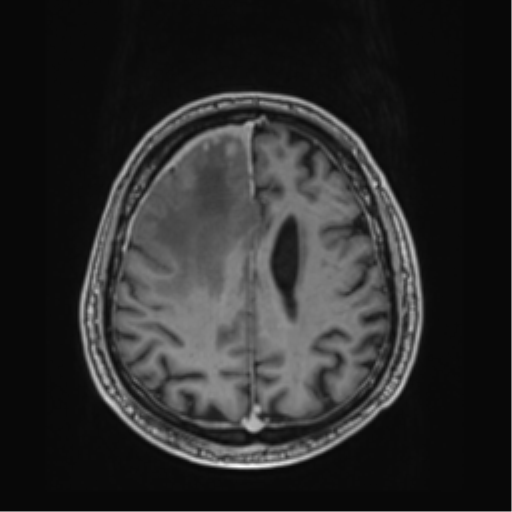 Atypical meningioma (WHO grade II) with brain invasion (Radiopaedia 57767-64729 Axial T1 C+ 35).png
