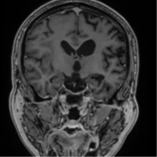 Atypical meningioma (WHO grade II) with brain invasion (Radiopaedia 57767-64729 Coronal T1 C+ 42).png