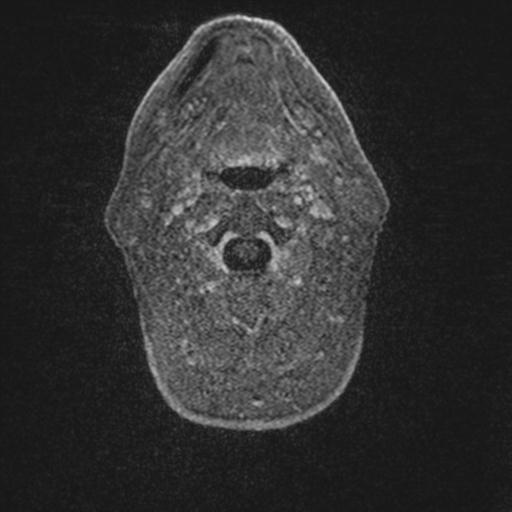 Atypical meningioma (grade II) - en plaque (Radiopaedia 29633-30147 Axial T1 C+ 1).jpg