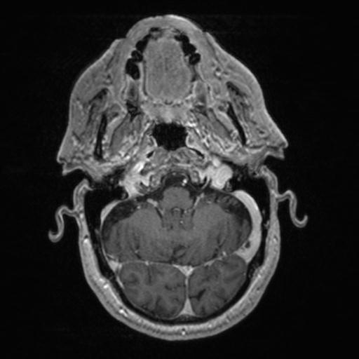 Atypical meningioma (grade II) - en plaque (Radiopaedia 29633-30147 Axial T1 C+ 45).jpg