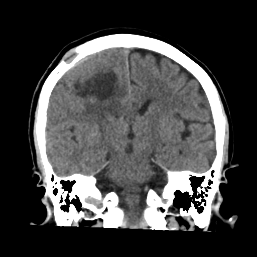 Atypical meningioma with skull invasion (Radiopaedia 34357-35649 Coronal non-contrast 36).png