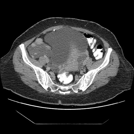 File:Atypical retroperitoneal lymphocoeles with large leiomyoma of uterus (Radiopaedia 32084-33024 A 29).jpg