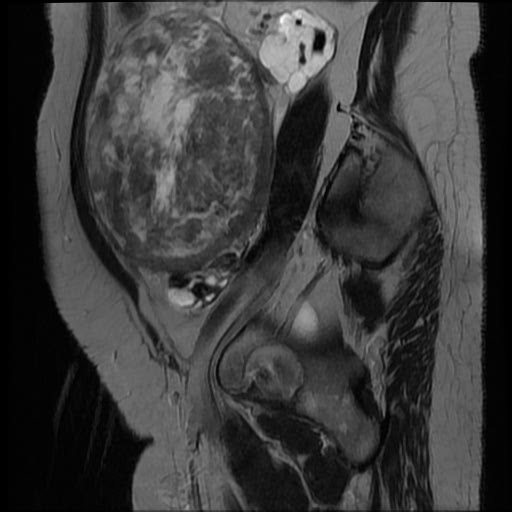 File:Atypical retroperitoneal lymphocoeles with large leiomyoma of uterus (Radiopaedia 32084-33027 Sagittal T2 7).jpg