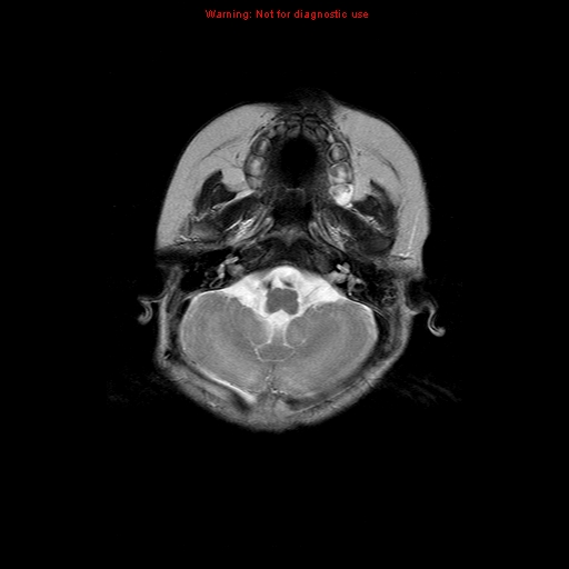 File:Atypical teratoid rhabdoid tumor (Radiopaedia 10712-11183 Axial T2 15).jpg