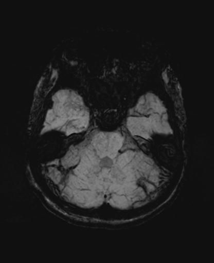 File:Autoimmune limbic encephalitis (Radiopaedia 30363-31005 SWI - mIP 21).jpg