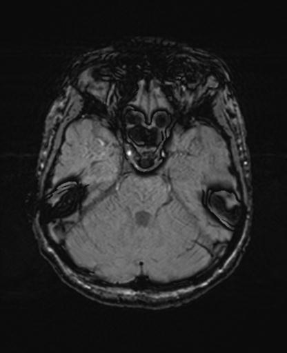 Autoimmune limbic encephalitis (Radiopaedia 30363-31005 SWI 24).jpg