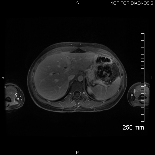File:Autoimmune pancreatitis (Radiopaedia 88443-105101 A 44).jpg