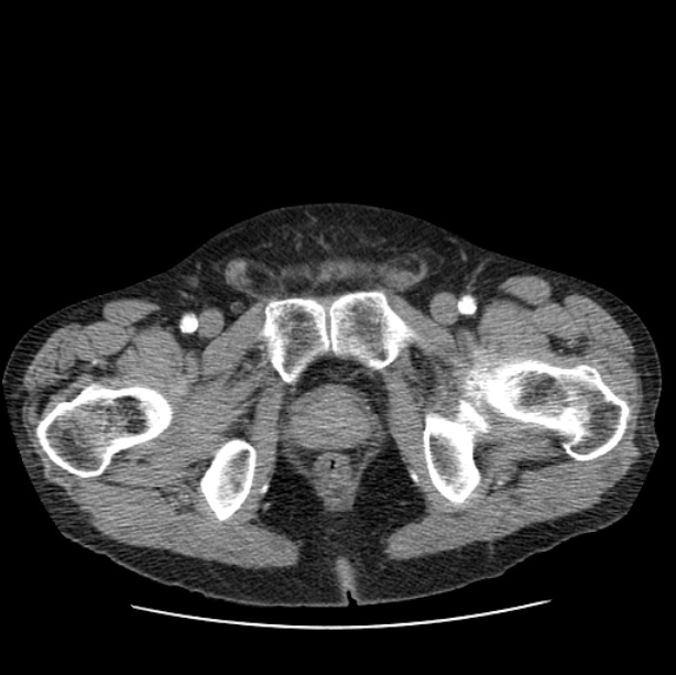 Autosomal dominant polycystic kidney disease (Radiopaedia 27851-28094 B 121).jpg