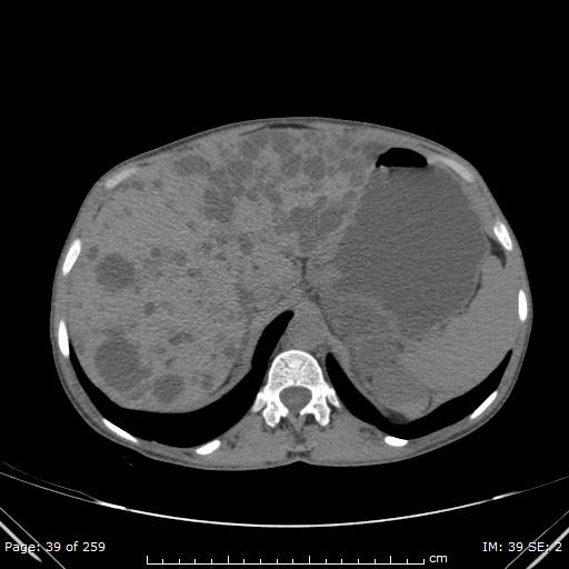 File:Autosomal dominant polycystic kidney disease (Radiopaedia 44122-47684 Axial 67).jpg
