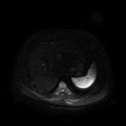 Autosomal dominant polycystic kidney disease (Radiopaedia 50259-55611 Axial DWI 81).jpg