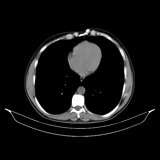 File:Autosomal dominant polycystic kidney disease (Radiopaedia 55750).jpg