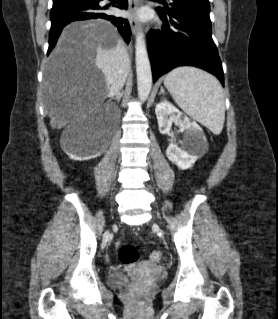 Autosomal dominant polycystic kidney disease (Radiopaedia 57124-64017 B 50).jpg