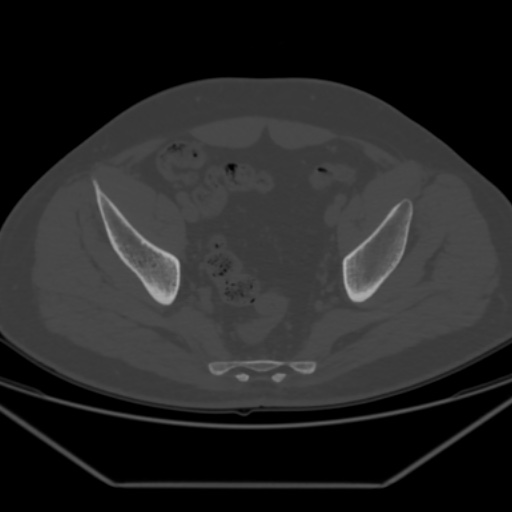 File:Avascular necrosis of the hip (Radiopaedia 61503-69467 Axial bone window 20).jpg