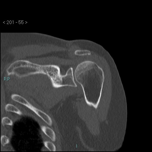 Avascular necrosis of the shoulder - Cruess stage I (Radiopaedia 77674-89887 Coronal bone window 54).jpg