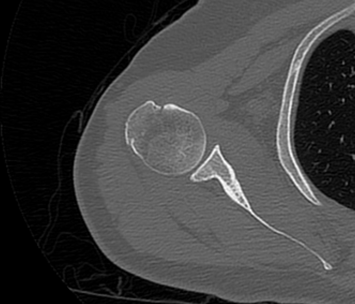 Avulsion fracture - greater tuberosity of humerus (Radiopaedia 71216-81514 Axial bone window 38).jpg