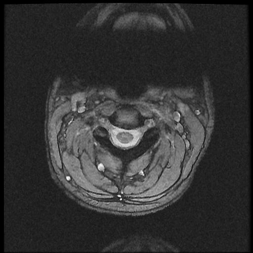 File:Axis fracture - MRI (Radiopaedia 71925-82375 Axial T2 fat sat 6).jpg