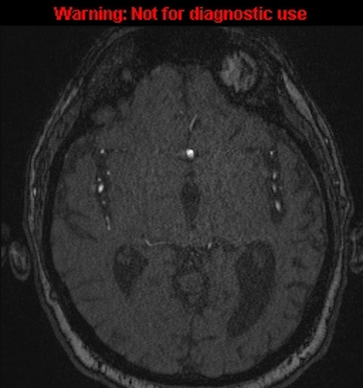 Azygos anterior cerebral artery (Radiopaedia 59325-66677 Axial MRA 79).jpg