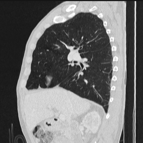 Azygos lobe (Radiopaedia 38259-40275 lung window 39).jpg