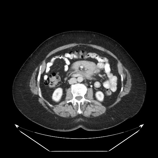 File:B-cell lymphoma of the mesentery (Radiopaedia 65711-74827 A 63).jpg