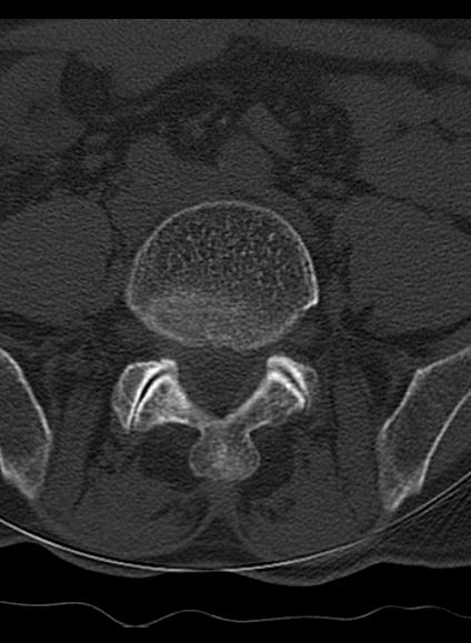 File:Baastrup syndrome (Radiopaedia 64891-73838 Axial bone window 11).jpg