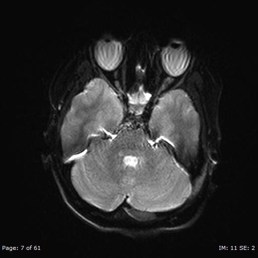Balo concentric sclerosis (Radiopaedia 61637-69636 Axial DWI 7).jpg
