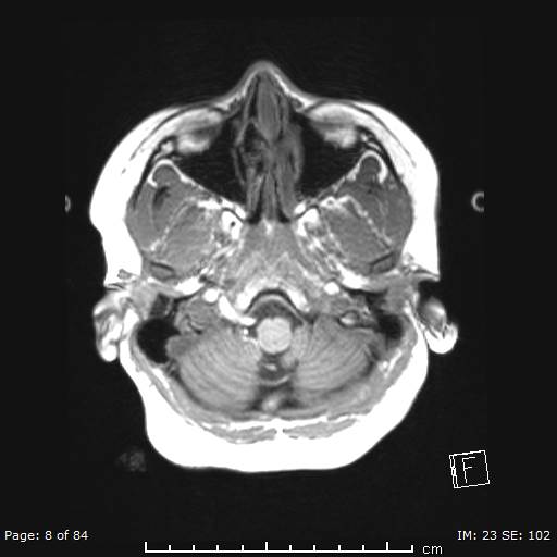 Balo concentric sclerosis (Radiopaedia 61637-69636 Axial T1 8).jpg