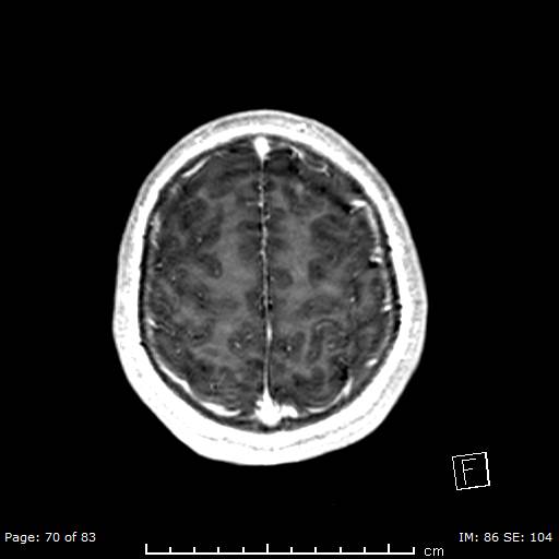 Balo concentric sclerosis (Radiopaedia 61637-69636 Axial T1 C+ 70).jpg