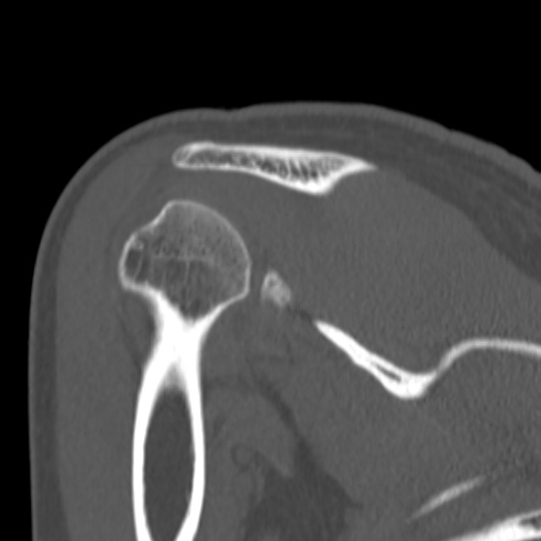 Bankart lesion (Radiopaedia 57256-64185 Coronal bone window 34).jpg