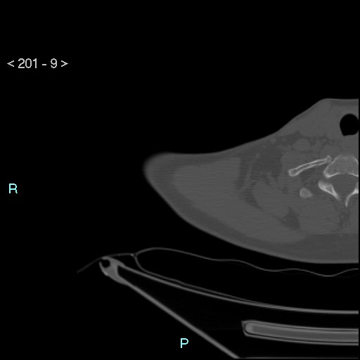Bankart lesion with glenoid bone defect - assessment TC with PICO method (Radiopaedia 42855-93901 Axial bone window 8).jpg