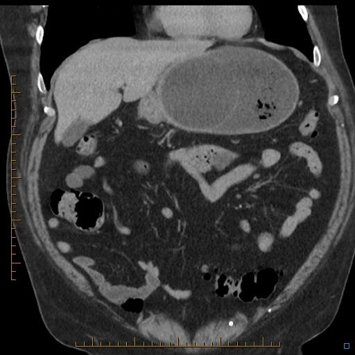 File:Bariatric balloon causing gastric outlet obstruction (Radiopaedia 54449-60672 B 18).jpg
