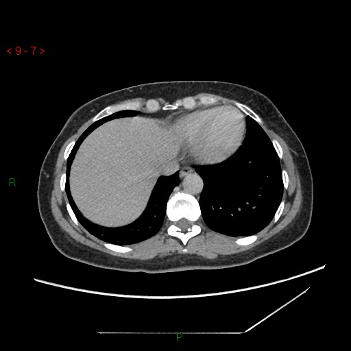 File:Bartholin gland cyst (Radiopaedia 54904-61181 Axial C+ delayed 2).jpg