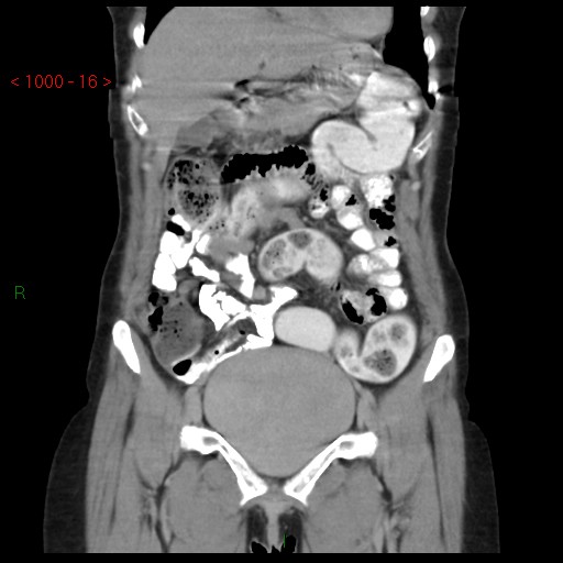 File:Bartholin gland cyst (Radiopaedia 54904-61181 Coronal C+ delayed 16).jpg