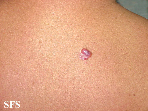 Basal Cell Carcinoma (Dermatology Atlas 101).jpg