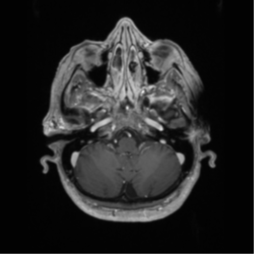 Basal ganglia metastasis (Radiopaedia 78928-91828 Axial T1 C+ 13).png