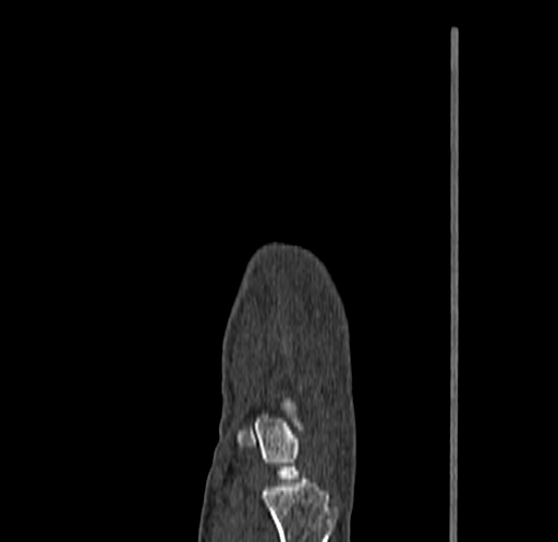 Base of 2nd metacarpal fracture (Radiopaedia 73741-84544 Sagittal bone window 29).jpg