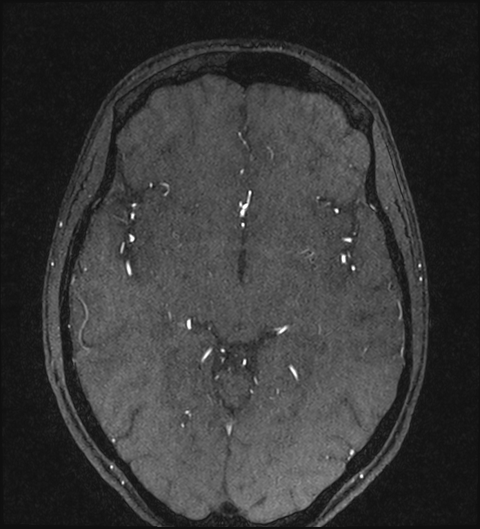 Basilar artery perforator aneurysm (Radiopaedia 82455-97733 Axial MRA 123).jpg