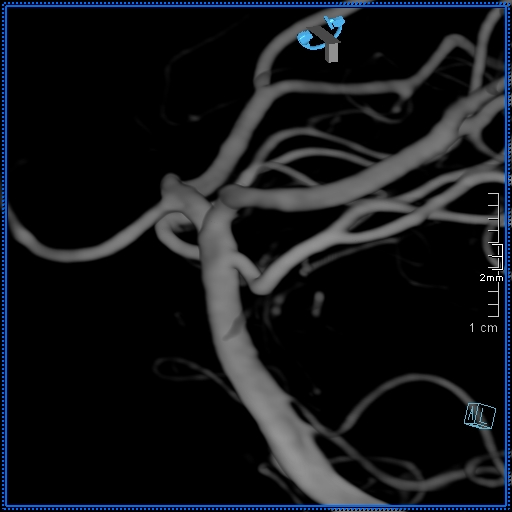 Basilar artery perforator aneurysm (Radiopaedia 82455-99524 3D Left VA 28).jpg