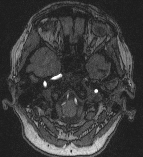 Basilar tip aneurysm (Radiopaedia 26504-26632 MRA 30).jpg