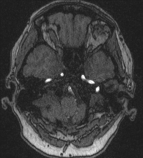 File:Basilar tip aneurysm (Radiopaedia 26504-26632 MRA 38).jpg