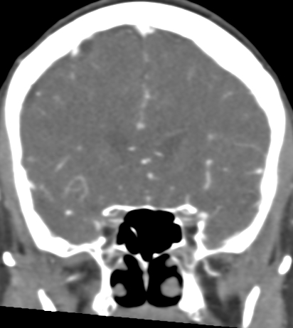 Basilar tip aneurysm with coiling (Radiopaedia 53912-60086 B 48).jpg