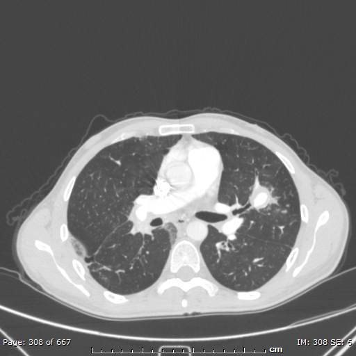 File:Behçet disease (Radiopaedia 44247-47889 Axial lung window 39).jpg