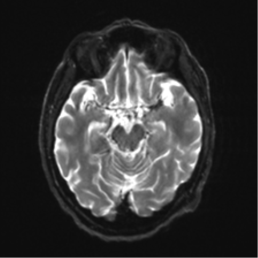 File:Behavioral variant frontotemporal dementia and late onset schizophrenia (Radiopaedia 52197-58083 Axial DTI Trace W 10).png